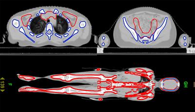 Clinical study of total bone marrow combined with total lymphatic irradiation pretreatment based on tomotherapy in hematopoietic stem cell transplantation of acute leukemia